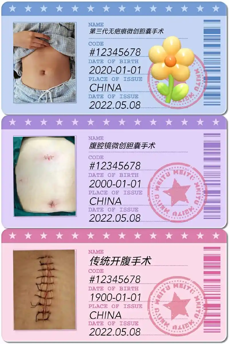 胆囊切除术式大致演变:开腹手术(来自网络参考图)-微创腹腔镜 - 抖音