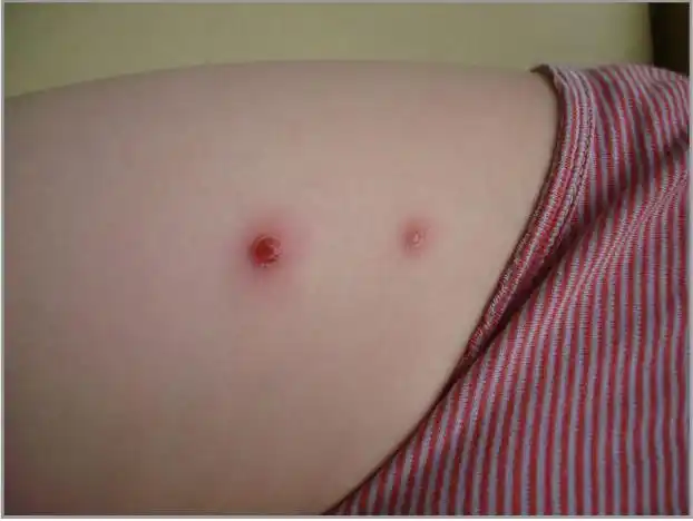 儿童会得皮肤淋巴瘤吗?应该如何诊断与治疗?