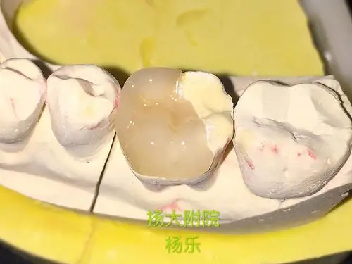 铸瓷高嵌体的应用 - 好大夫在线