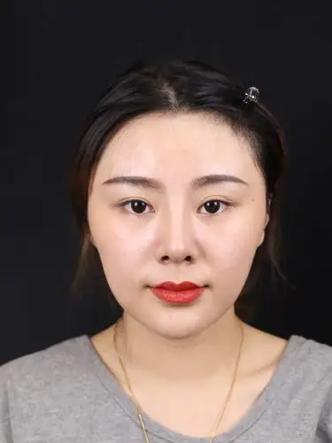 术前分析从正面看姑娘的鼻子鼻头比较大鼻翼偏宽且鼻孔露出比较多所以