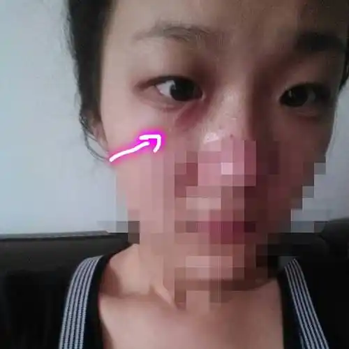 大概在一个月前某天早上起床,我就发现我的眼睛上鼓起了一个细长的包