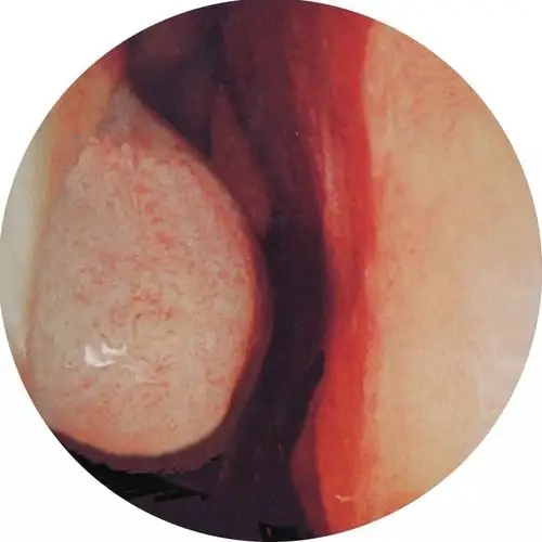 肥厚性鼻炎是由单纯性鼻炎转化而来,因此肥厚性鼻炎的一般症状