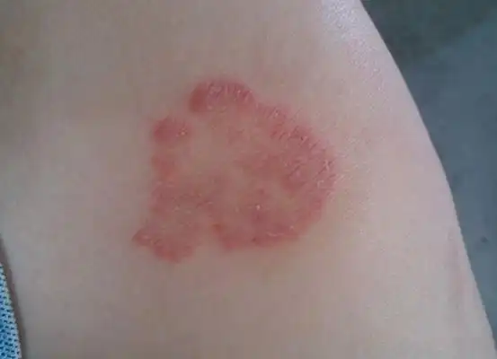 皮癣图片27
