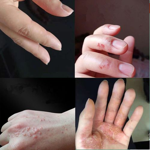 手脱皮季节性修复霜手掌手指头蜕皮开裂干裂维生素手起皮掉皮爆皮