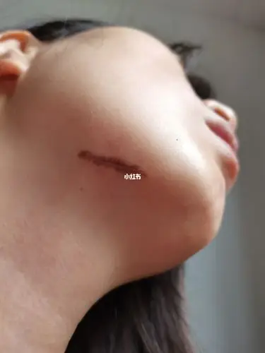 黑毛痣手术一个月_美妆_医美_整容_美妆_医美整形