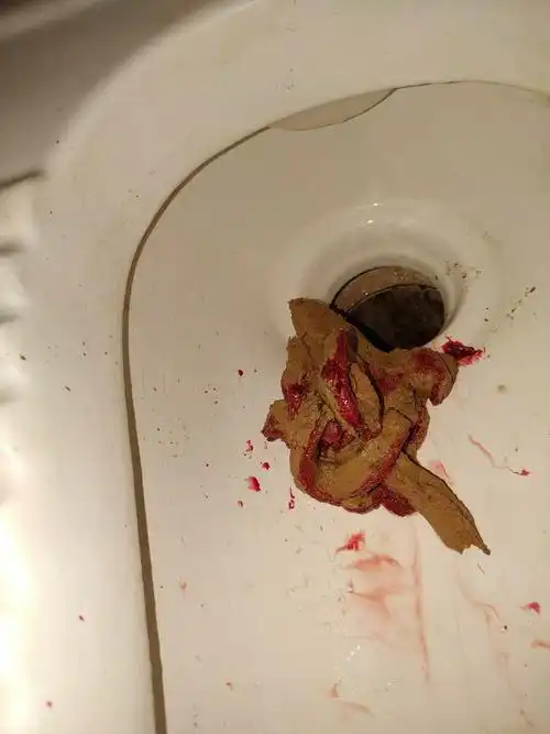 拉屎出血是不得病了,拉的时候什么感觉都没有,也不会痛.