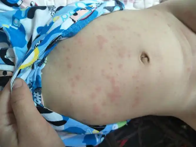 宝宝得了荨麻疹怎么办能不能根治