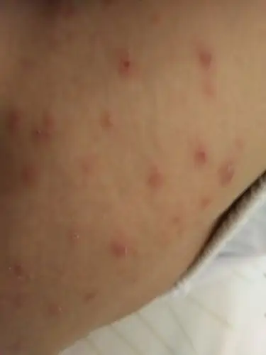 天气太热了大腿内侧长红豆还很痒这是皮炎还是湿疹