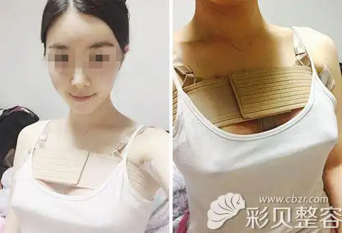 深圳富华曹孟君曼托假体隆胸术后第7天效果图