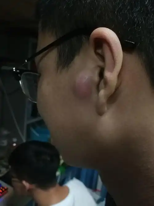耳朵附近长了个包该怎么办