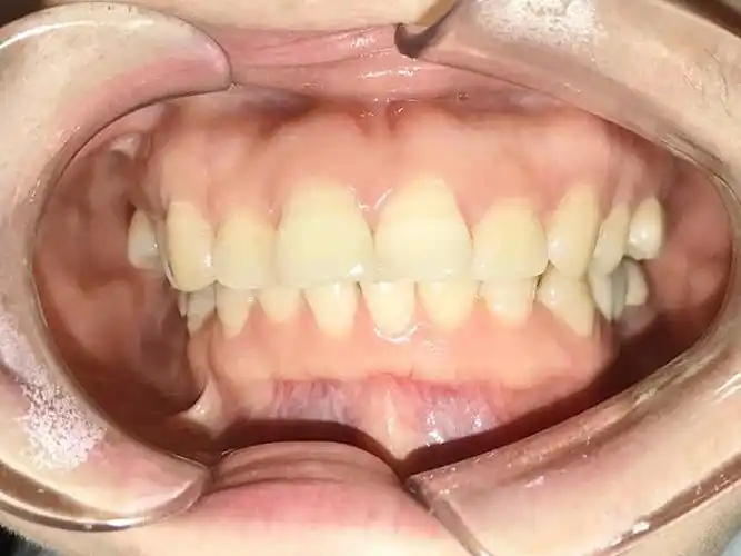 体验前变美诉求:门牙有一颗外凸,牙龈有点萎缩了,想_圈子-新氧美容