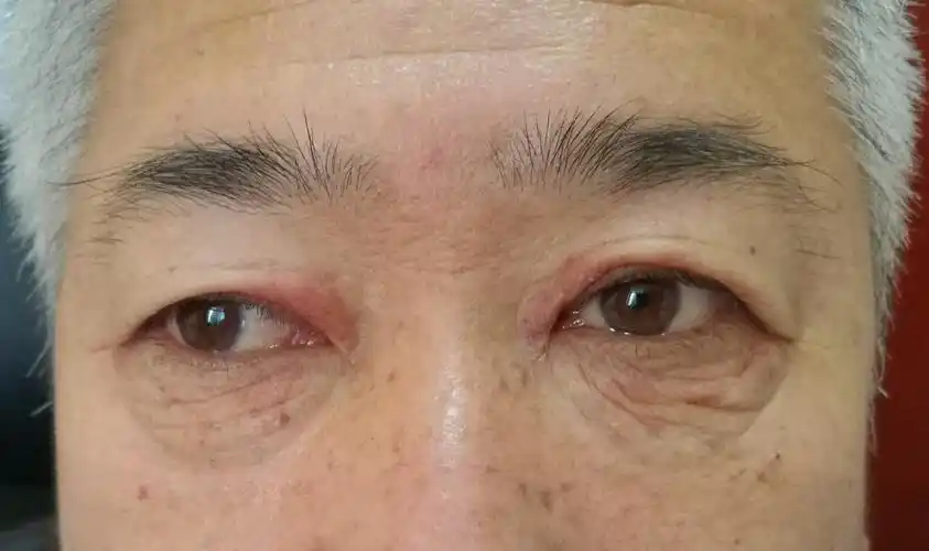 图49眼睑湿疹(男,51岁)图50手背皮肤湿疹(同上)图51双多关节炎,雷诺