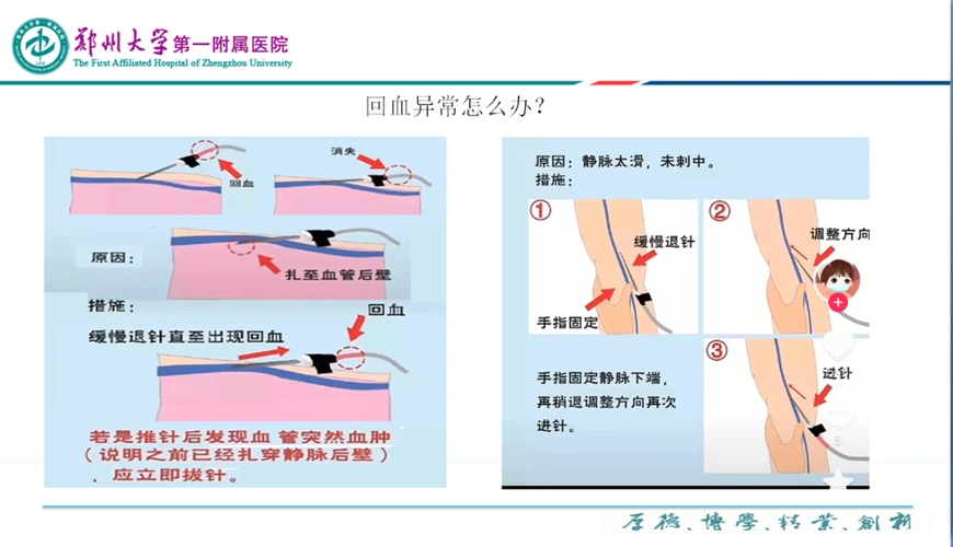 静脉采血如何做到快准稳