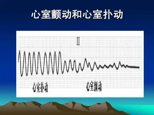 心室颤动和心室扑动