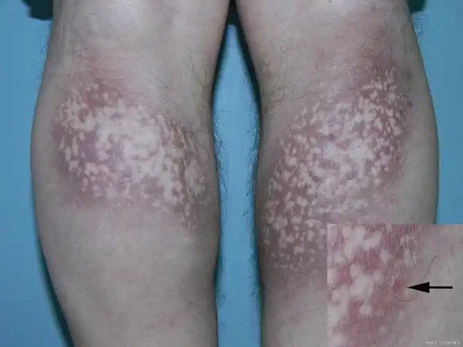 诊断 处理皮肤异色病样皮肤淀粉样变性  口服阿维a 30mg/d治疗1月后