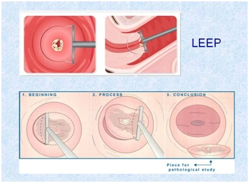 leep的优势是操作相对简单,在门诊就可以进行,一般不需要麻醉.