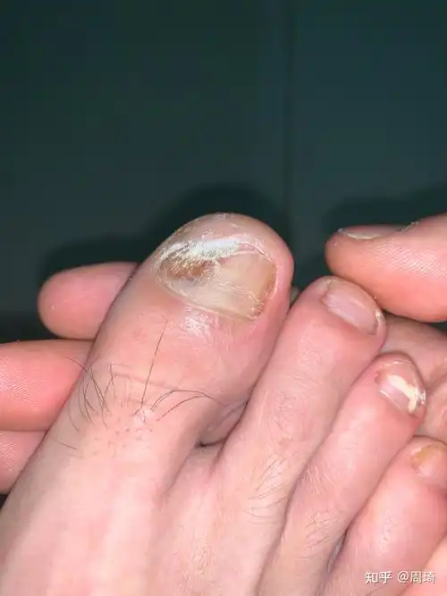 经常打篮球现在脚趾甲变厚变硬按压还有痛感想知道是什么个情况