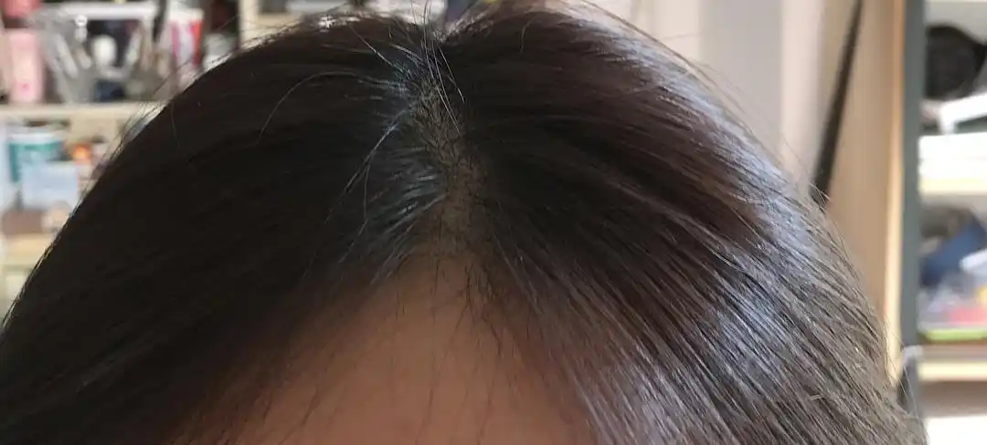 请问我这算发缝过宽或头秃吗?