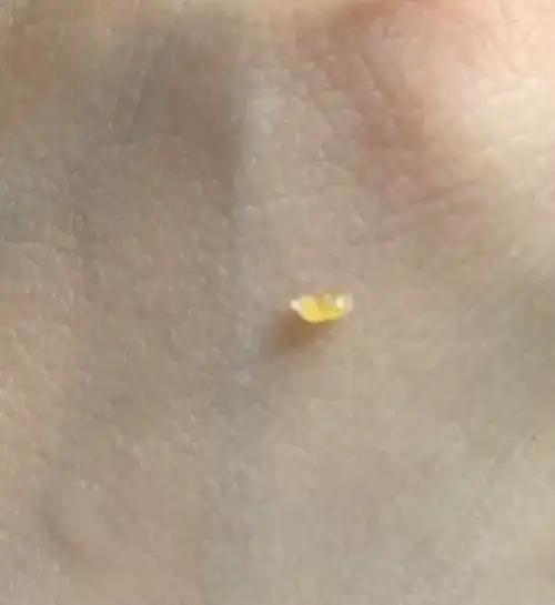 家人们我刚刚挤出来一个巨大的黑头会不会有事(有图慎入)