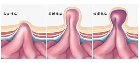 小儿疝气的治疗