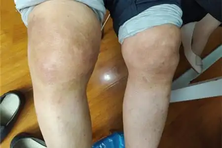 类风湿治疗要达到这几个目的,止痛只是第一步!