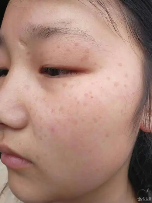 皮肤疾病猜图积分大派送309汗孔角化症