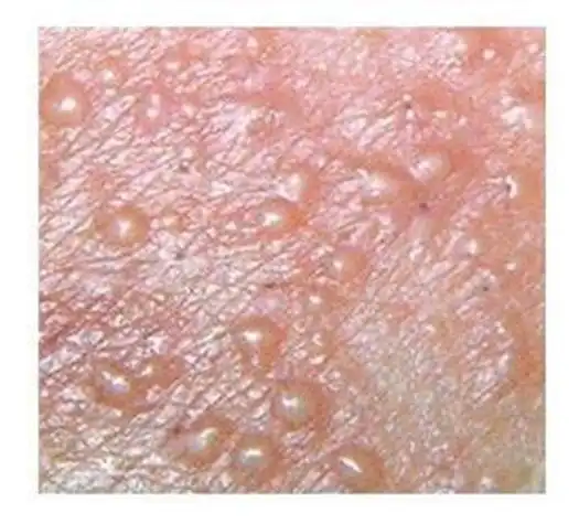 男性生殖器疱疹的初期症状图片_有来医生