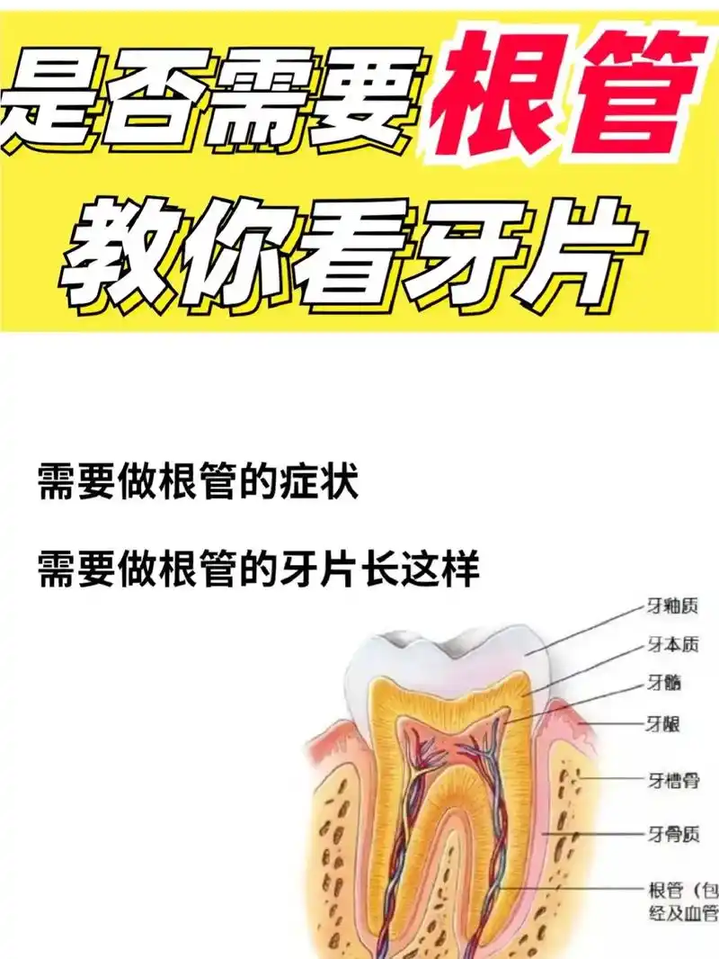要不要做根管治疗,就看这2点!很多人都在问我,怎么判断自己的 - 抖音