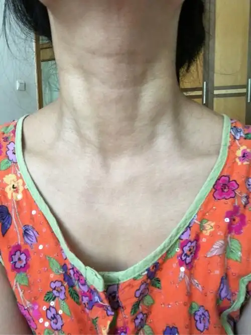 请各位大神帮我看看,我是淋巴瘤么?