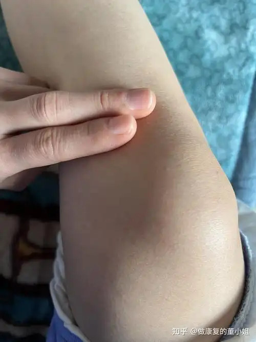 如何自行区分鹅足腱滑膜炎和半月板损伤