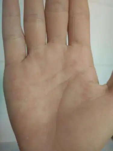 为什么我手上长那么多红点点,在网上查说是艾滋病别吓我啊