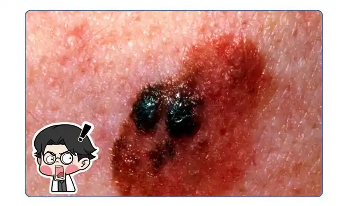 头皮里老是长疙瘩和脓包是怎么回事有可能是这4种疾病惹的祸