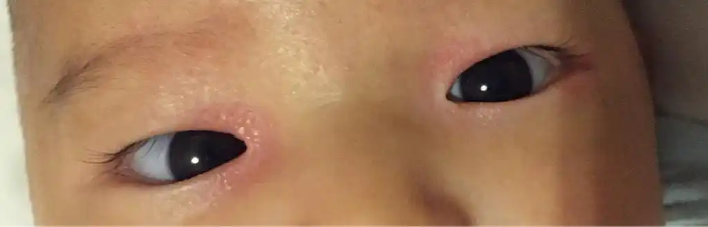 请帮我看看宝宝眼睛外一圈红了怎么处理?