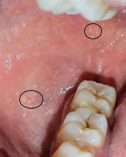 【口腔】口腔颌面部常见被误解为病变的正常结构-第1章