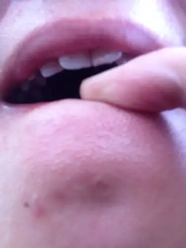 下颚长好多白点点小痘痘,用手去了,过几天又出来了,求大神指点