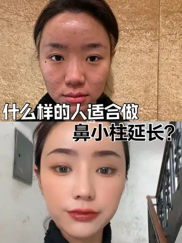 什么样的人适合做鼻小柱延长?_唇部_鼻小柱延长_美妆_医美整形