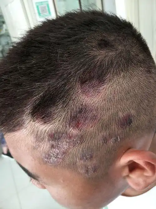 十五岁小男孩头部银屑病,周转在省城几家大医院治疗,没效果.