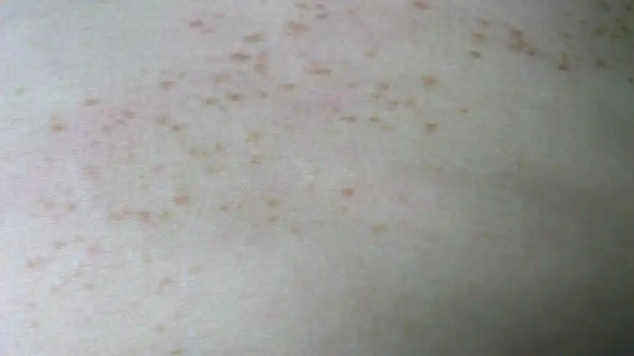 最近生活习惯上也没其它特别,为什么这黄斑会突然扩散,有何治疗方法吗