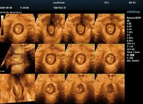 开展盆底超声检查 关爱女性"难言之隐"