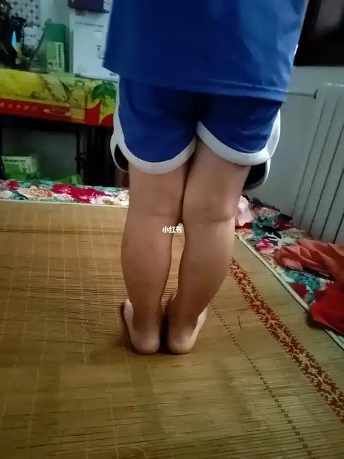 3岁半小孩这样的腿型正常吗