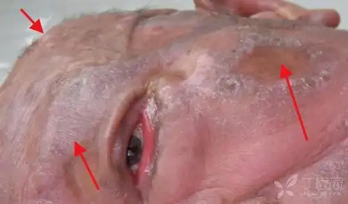 二,毛囊型蕈样肉芽肿顾名思义,皮损以好累及毛囊为特征, 糜烂渗出者