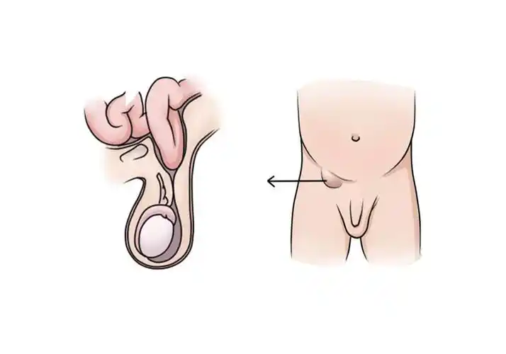 男人疝气有哪些症状?男性疝气有什么症状?-图片大观-奇异网