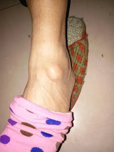 脚踝长了个包 这是什么病 长了快半年了