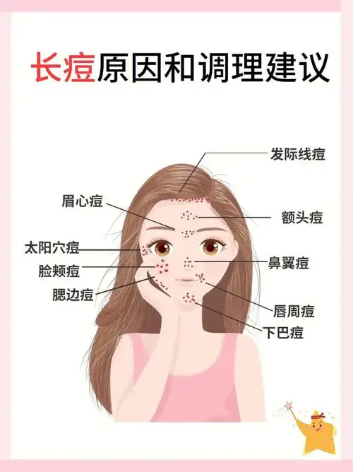 常年长痘痘一定要看73痘痘类型和对应攻略99