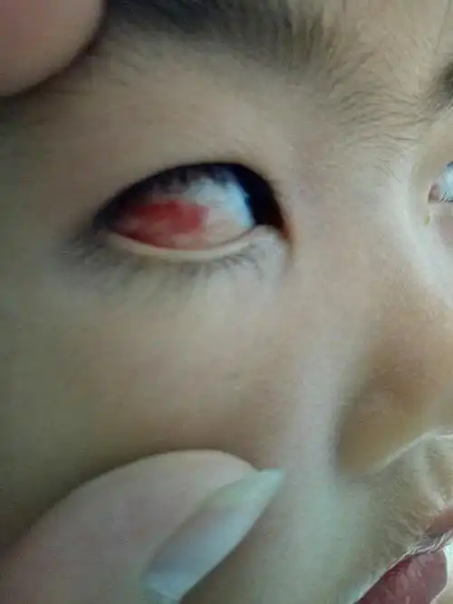 宝宝眼睛眼屎多红肿眼白鲜红