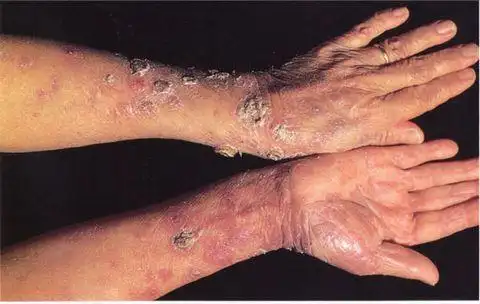 性病知识——梅毒(二)