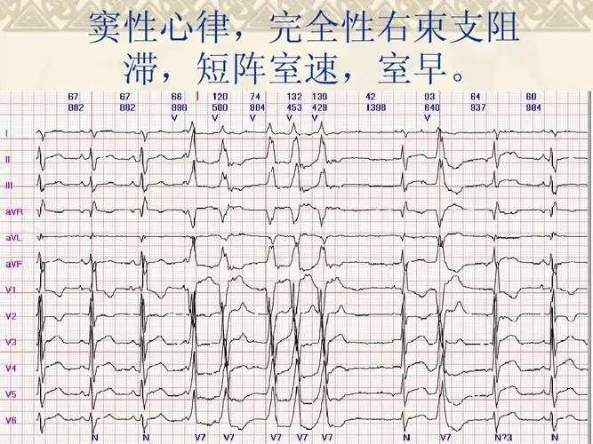 窦性心律,完全性右束支阻 滞,短阵室速,室早.