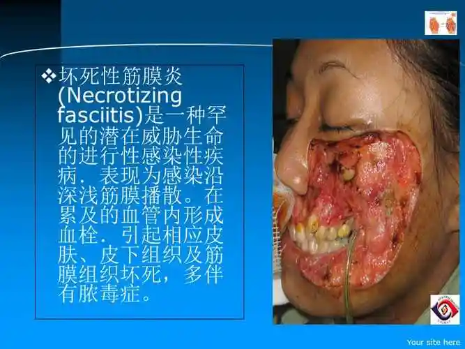 坏死性筋膜炎讲解学习