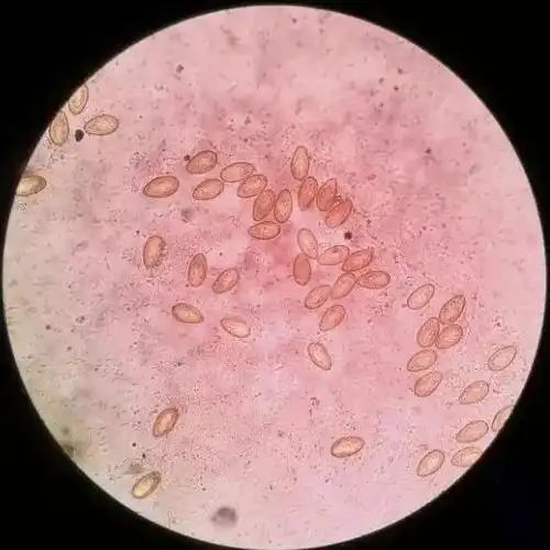 肝吸虫卵如此高清照片赶快收藏