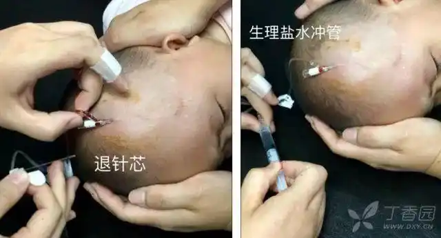 实用经验分享:小儿头皮针穿刺技巧_静脉